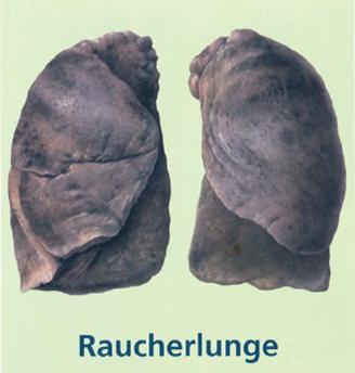 Raucherlunge