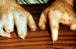 Durchblutungsstörung in der Hand